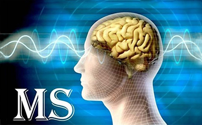 همه چیز درباره ام اس (MS) همه چیز درباره ام اس (MS)